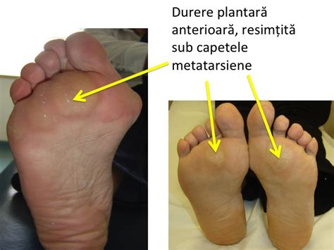 Genunchi durere de rulare picior. Durerea de Genunchi | Formthotics în România